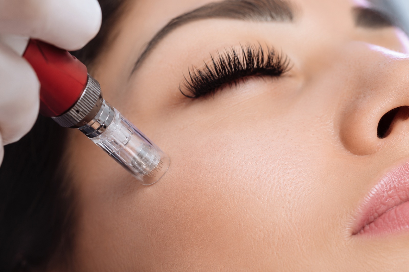 Dermapen (Microneedling)