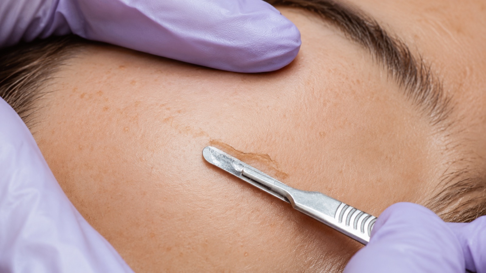 Dermaplaning